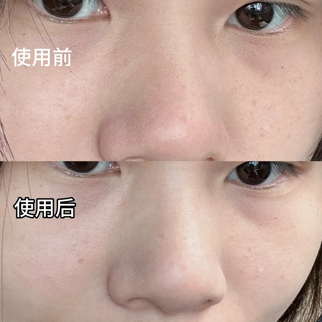 彩光嫩肤祛斑吗