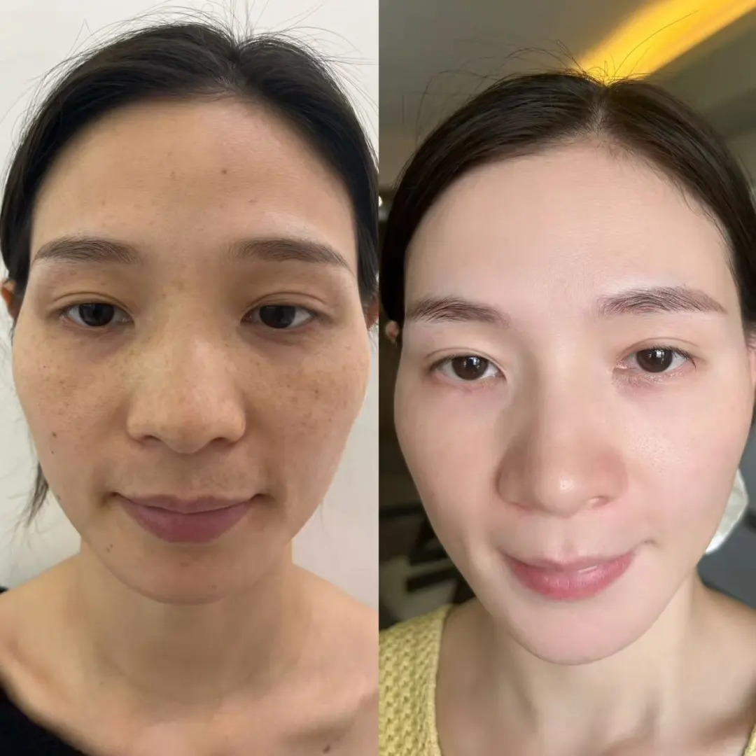 采光祛斑效果好吗